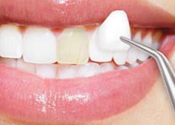 veneers gummy smile correction